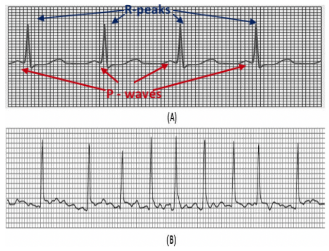 Atrial Fibrillation detection using simple and low-dimensional classifiers.